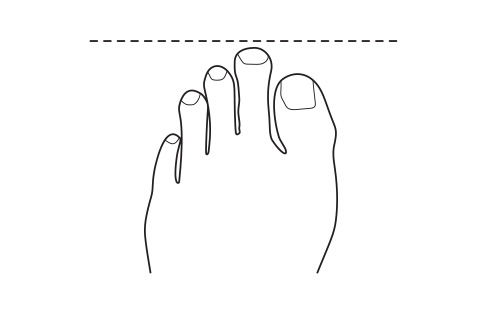 Short big toe