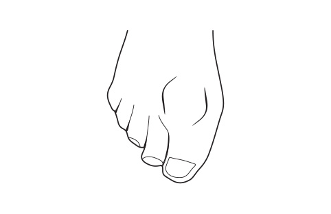 Arthritic big toe